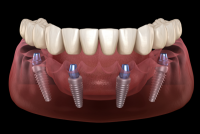 Dental Implant.png